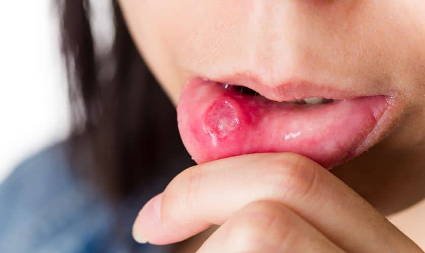 kids mouth ulcer.