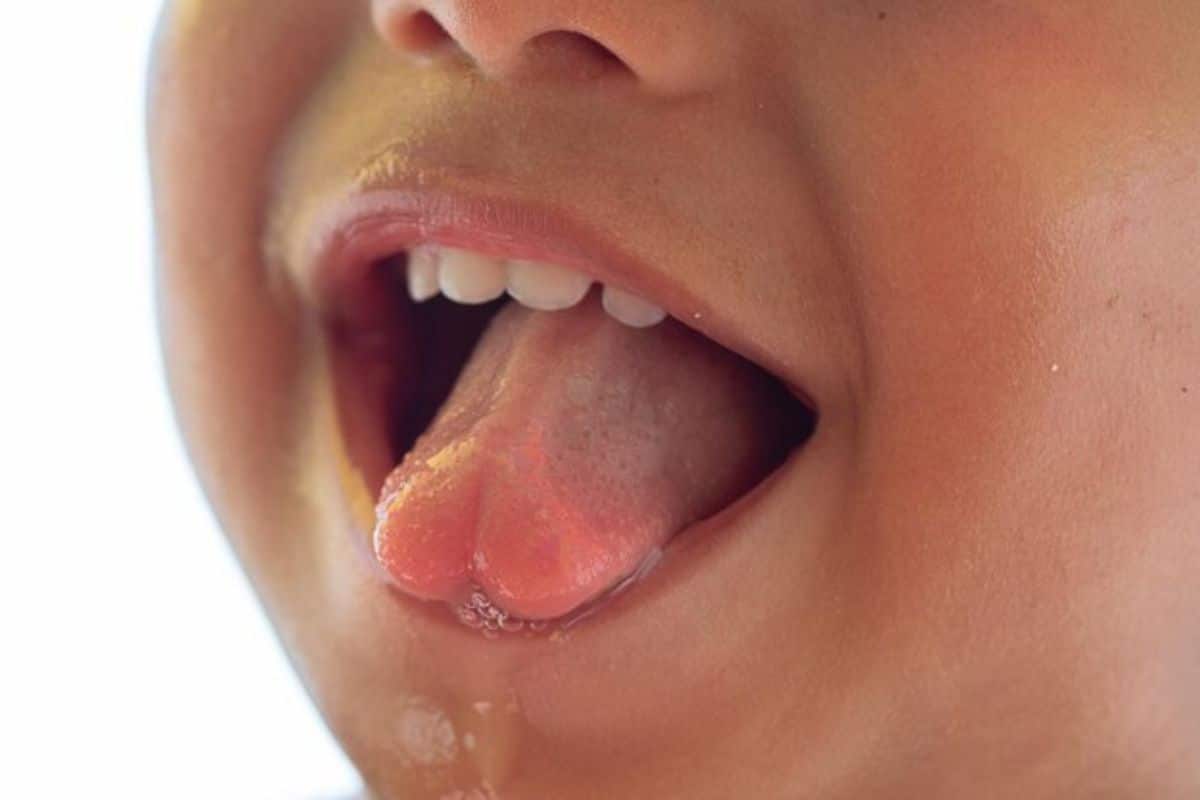 Tongue Itchy and Sore