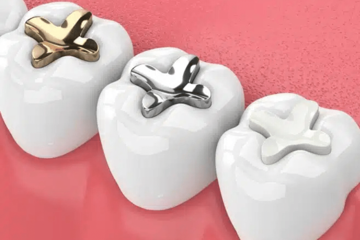 pediatric dental filling